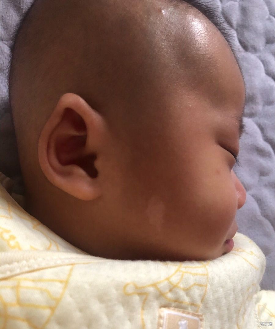 宝宝脸上白色这块这是胎记吗感觉越长越大了