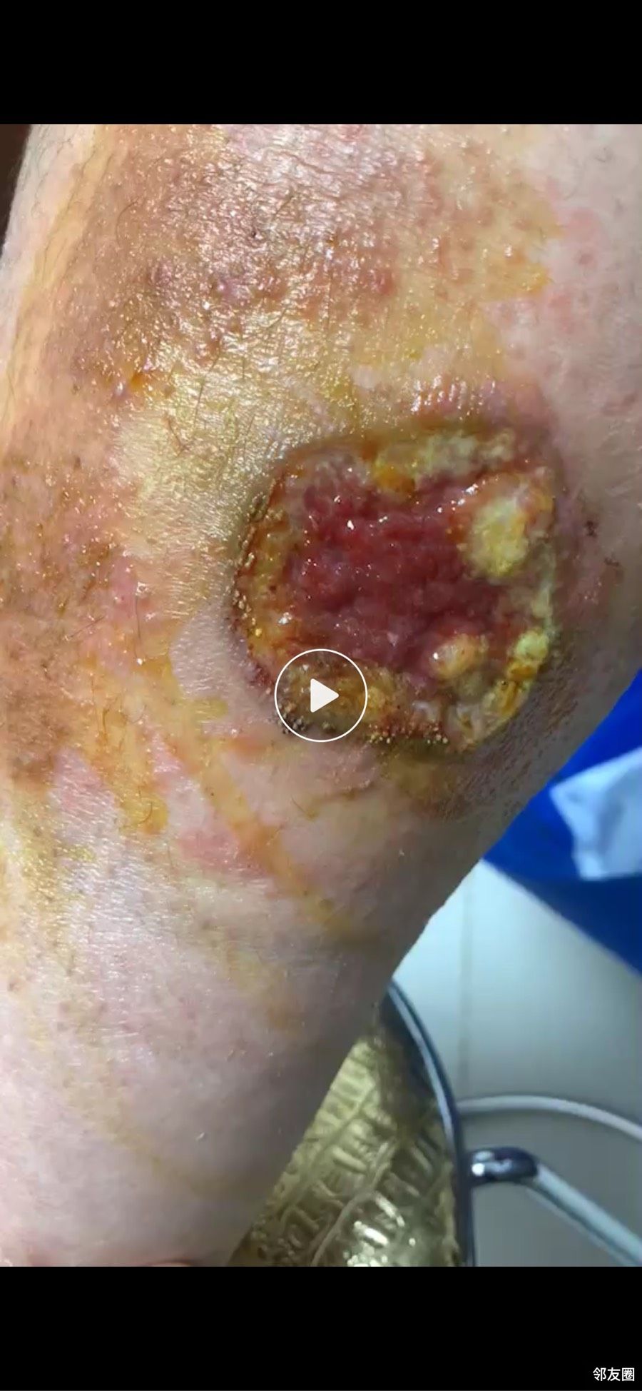 我很有可能是个傻子艾灸出了三个大水泡