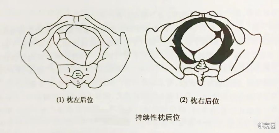 胎位不正,别慌~听助产士说胎位不正也能顺产! - 邻友圈